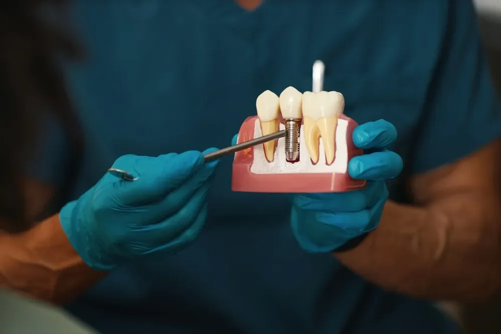 What Are Dental Implants? A Complete Beginner’s Guide